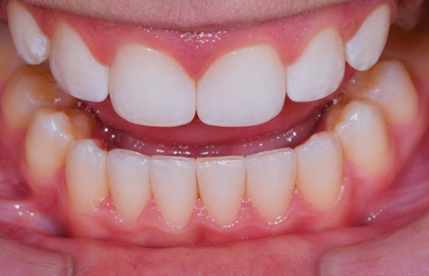 Después: dientes alineados